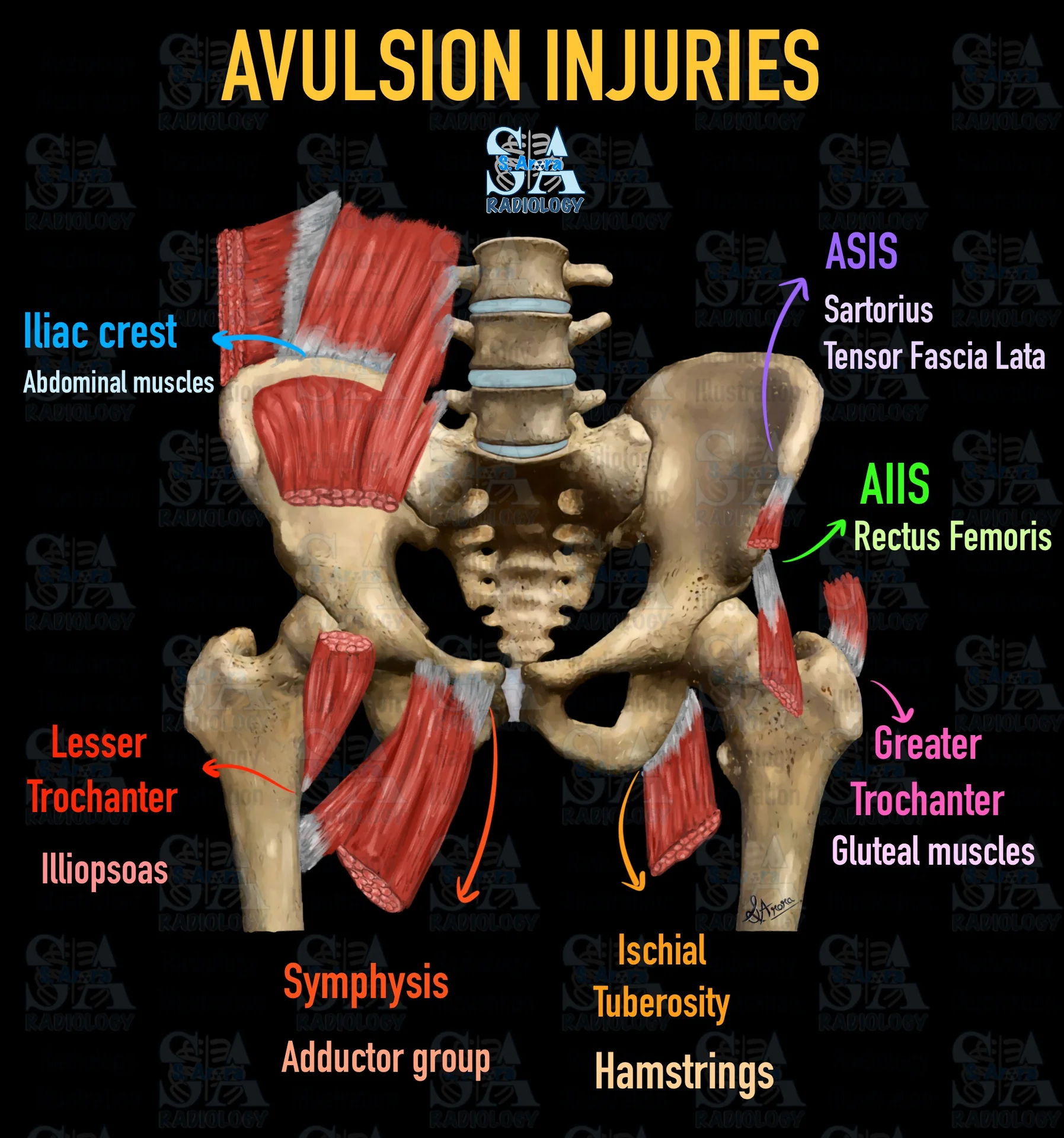 Manod Sign Radiology Illustration