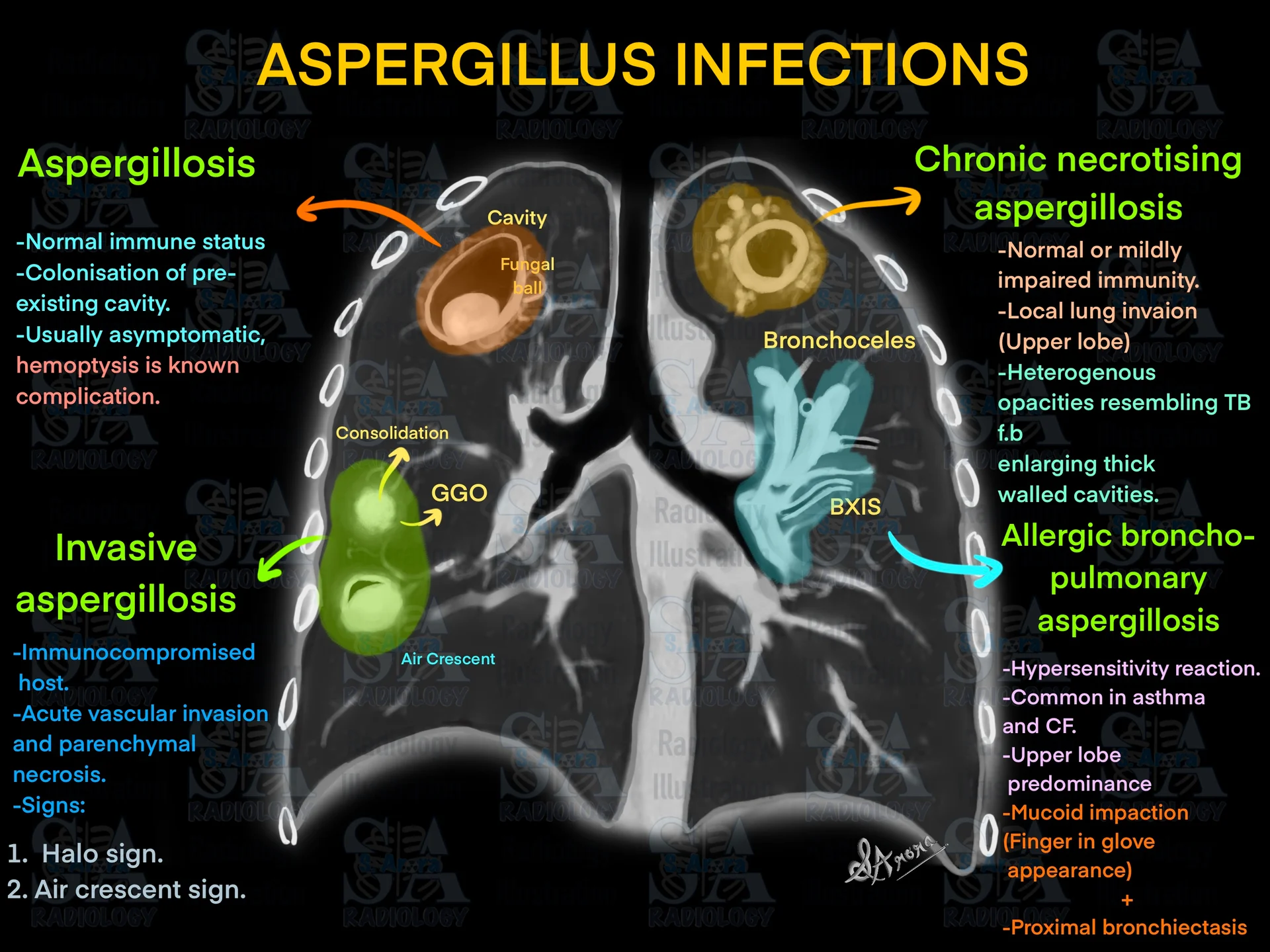 Manod Sign Radiology Illustration